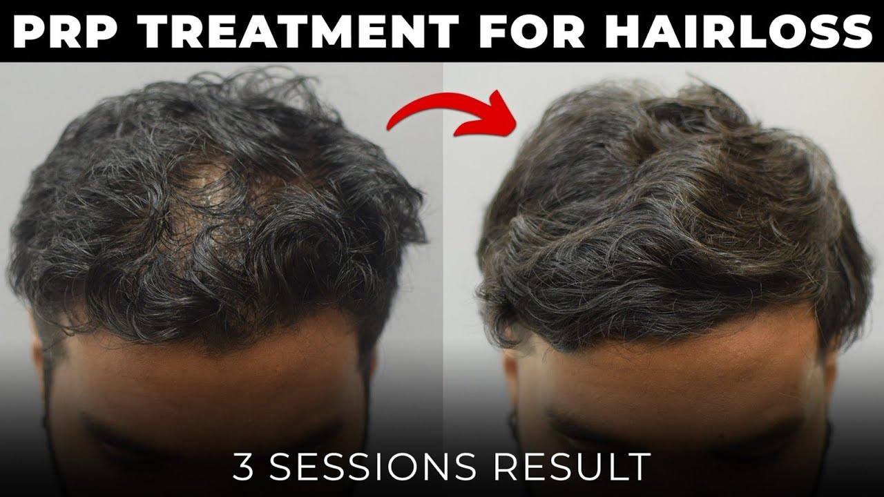 PRP Hair Loss Treatment Results | 3 Sessions Result #prptreatment