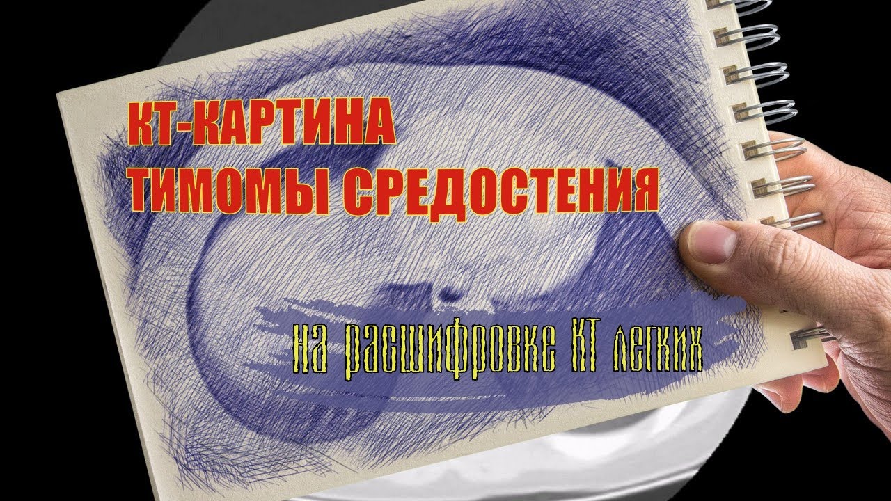 КТ картина ОБРАЗОВАНИЯ СРЕДОСТЕНИЯ (вероятно тимома) на РАСШИФРОВКЕ КТ грудной клетки