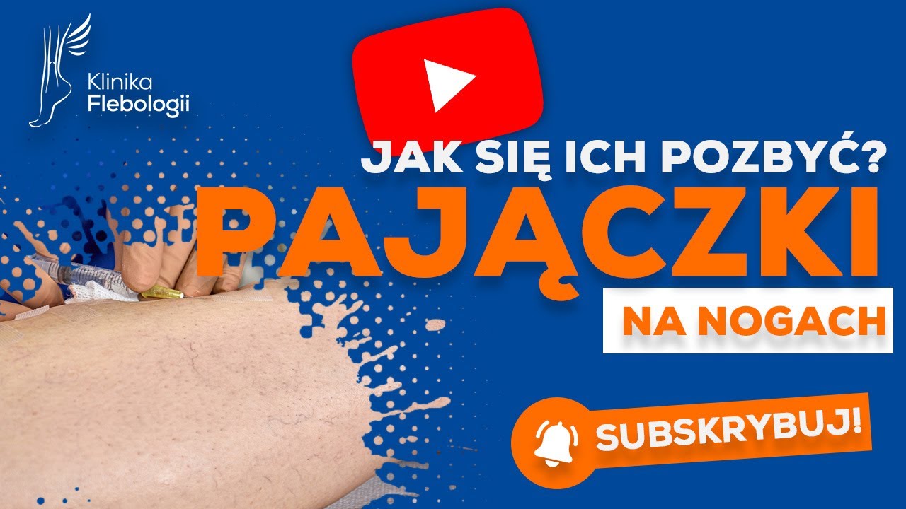Pajączki na nogach - jak się ich pozbyć?