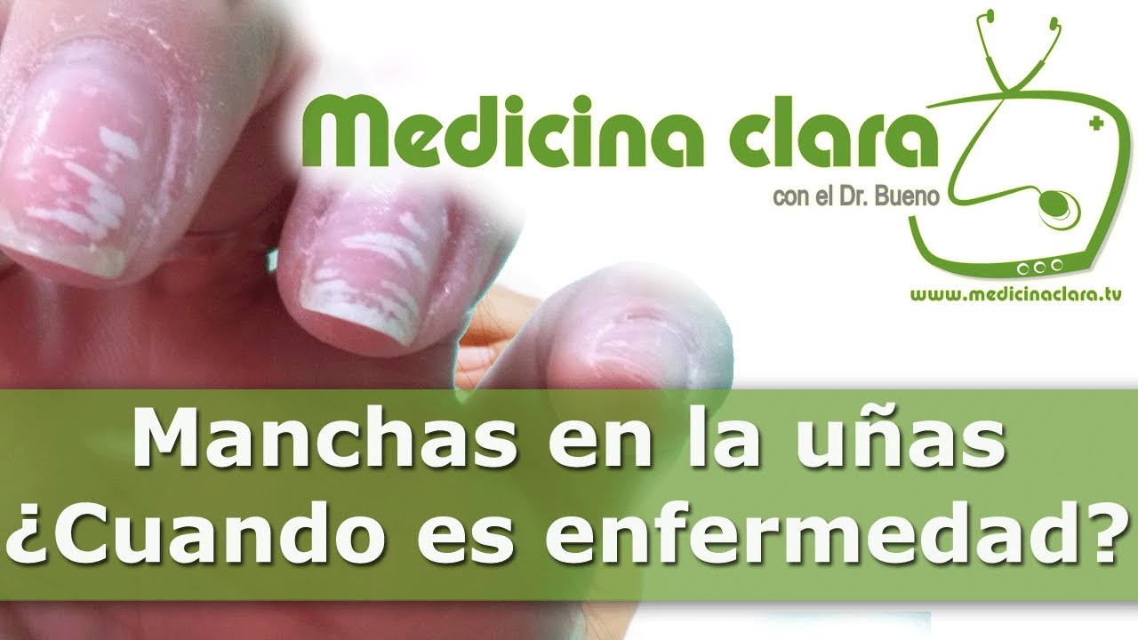 Manchas en las uñas, ¿por qué aparecen manchas  blancas en uñas?