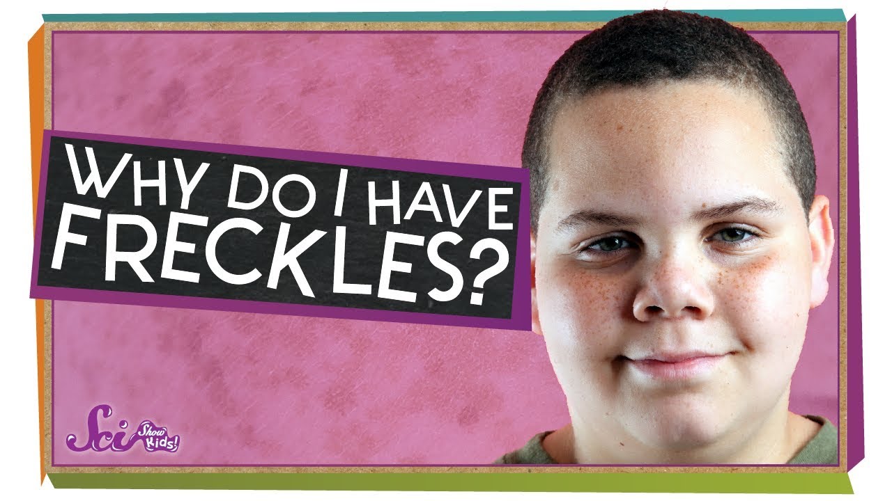 Why Do I Have Freckles?