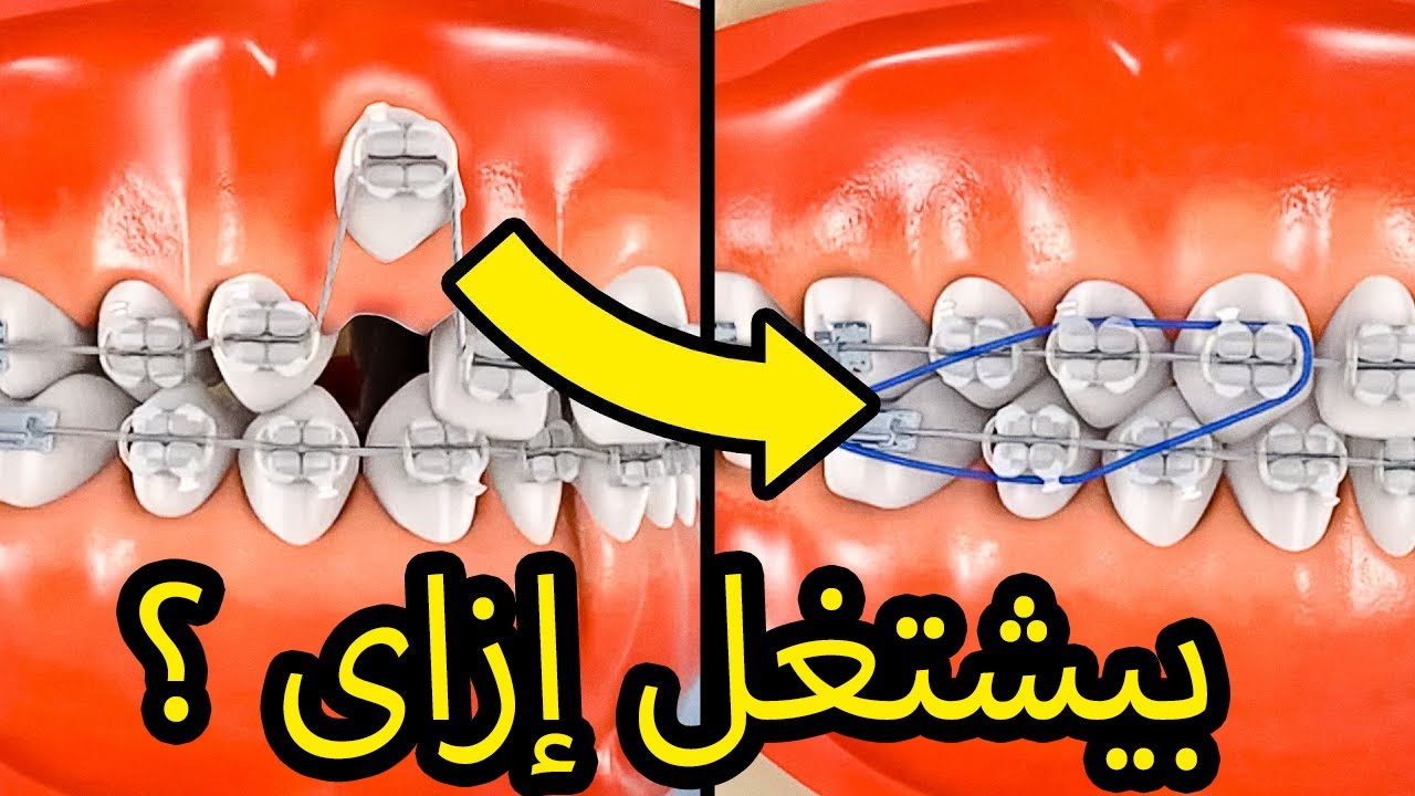 كيف يعمل تقويم الأسنان ؟