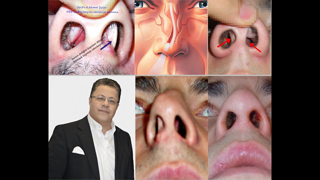 Burun tıkanıklığı, Kıkırdak eğrilikleri, burun etleri nedenleri ve tedavileri*Op.Dr.Ali Ahmet Şirin