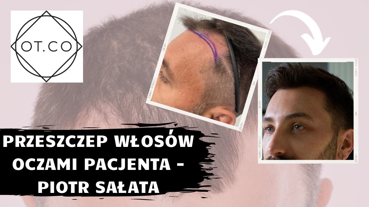 Przeszczep włos&oacute;w oczami pacjenta - Piotra Sałaty - OT.CO Clinic