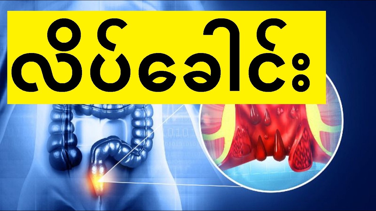 လိပ်ခေါင်းရောဂါကြောင့် စိတ်ညစ်နေသူများ ဒီဗီဒီယိုကို ကြည့်ပါ။