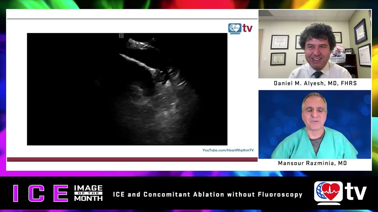 ICE Image of the Month: ICE and Concomitant Ablation without Fluoroscopy