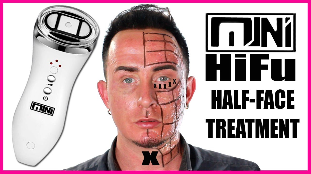 Обучающее видео по мини-аппарату Ultherapy Mini Hifu | Высокоинтенсивный фокусированный ультразву...