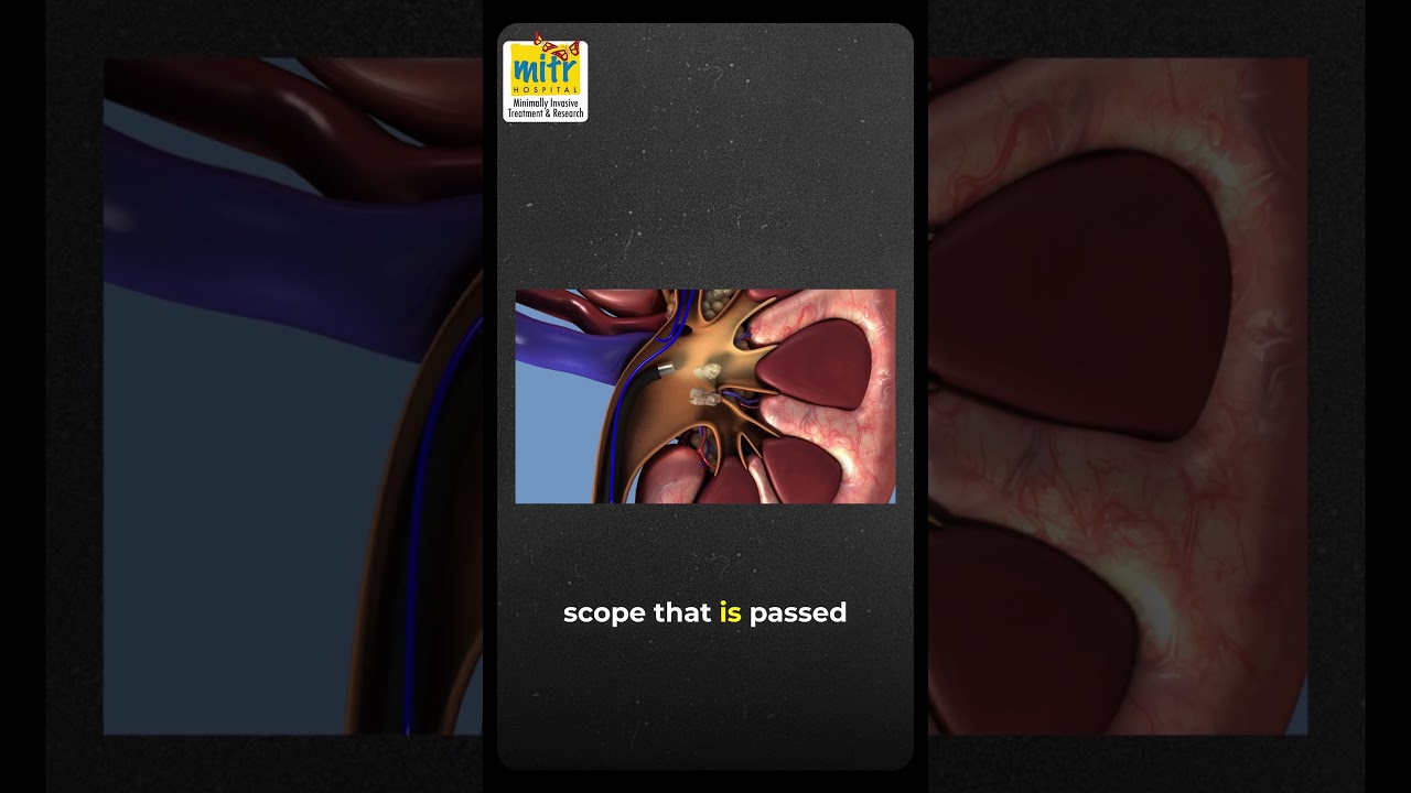 Kidney Stone Surgery Explained | Minimally Invasive Laser & Scope Techniques by Dr. Manish Dubey