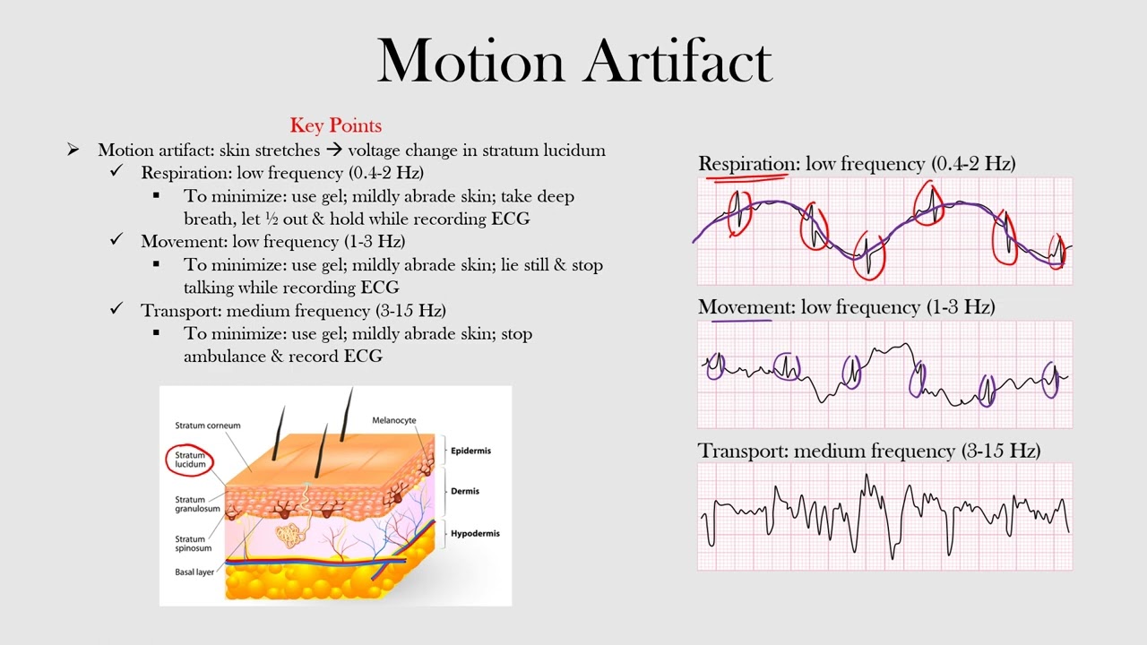 Motion Artifact