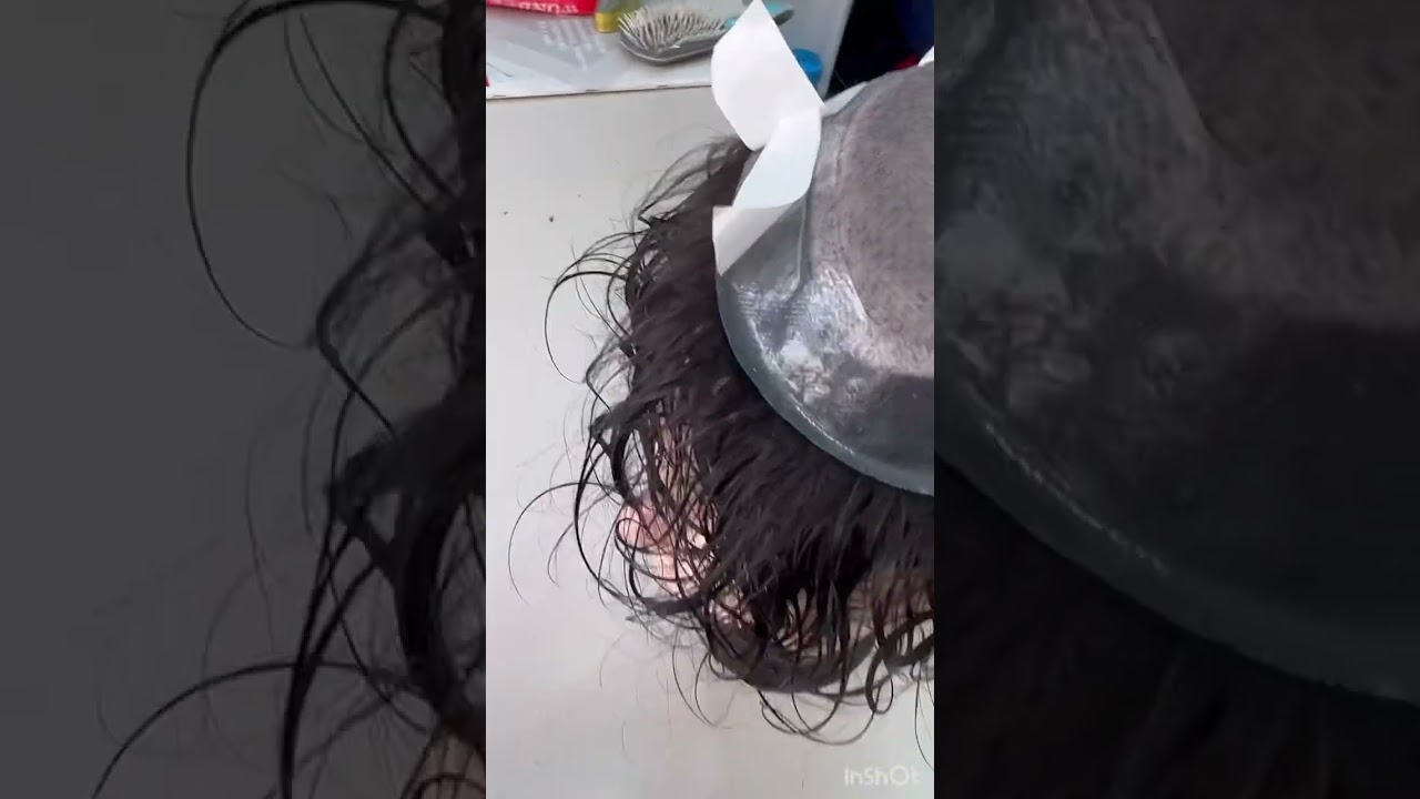 Australian hair patch taping technique ￼