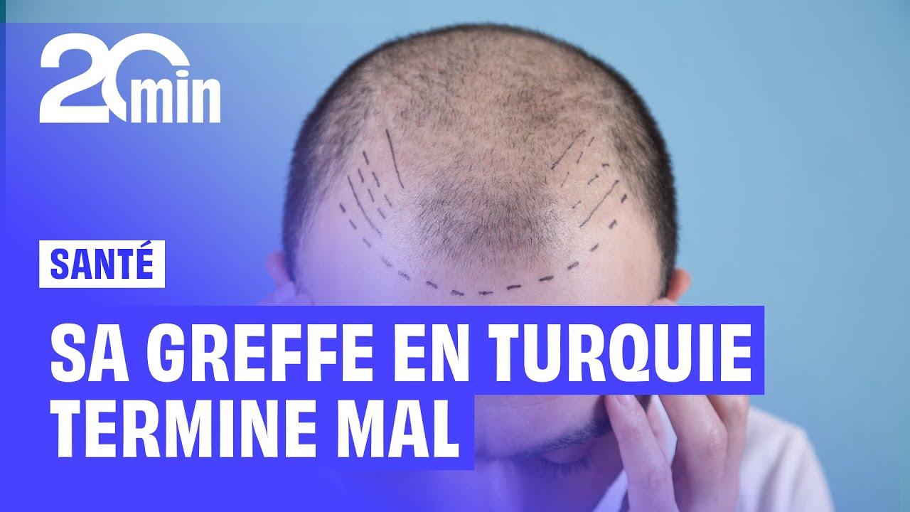 « On m'a charcuté »... Après une greffe ratée en Turquie, Clément doit tout recommencer en France