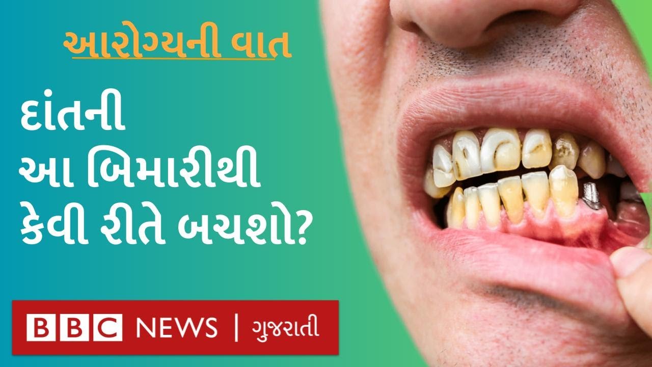 Pyorrhea શું છે અને એનાથી બચવા શું કરવું? : Health Explainer