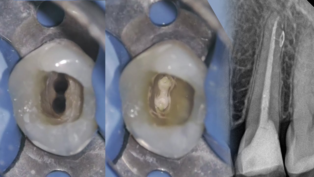 Root Canal Treatment Using Denco Pro Flexi File