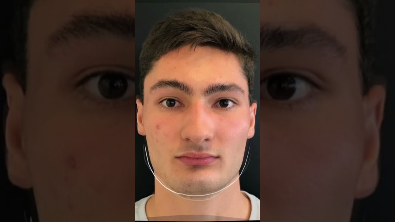 Cirurgia Ortogn&aacute;tica-  A harmoniza&ccedil;&atilde;o facial definitiva 😱 #shorts #cirurgiaplastica #ortogn&aacute;tica