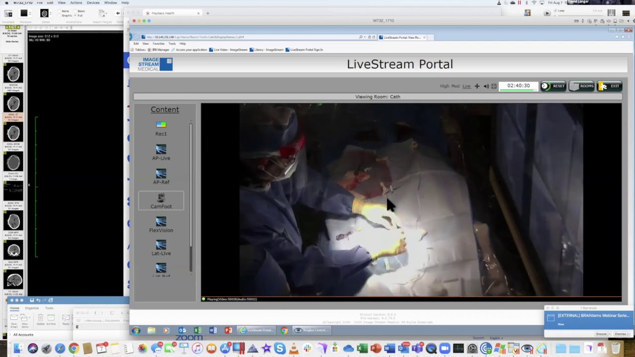 Chairman's corner: Endovascular Coiling for Brain Aneurysm with Dr. Langer and Dr. Ortiz