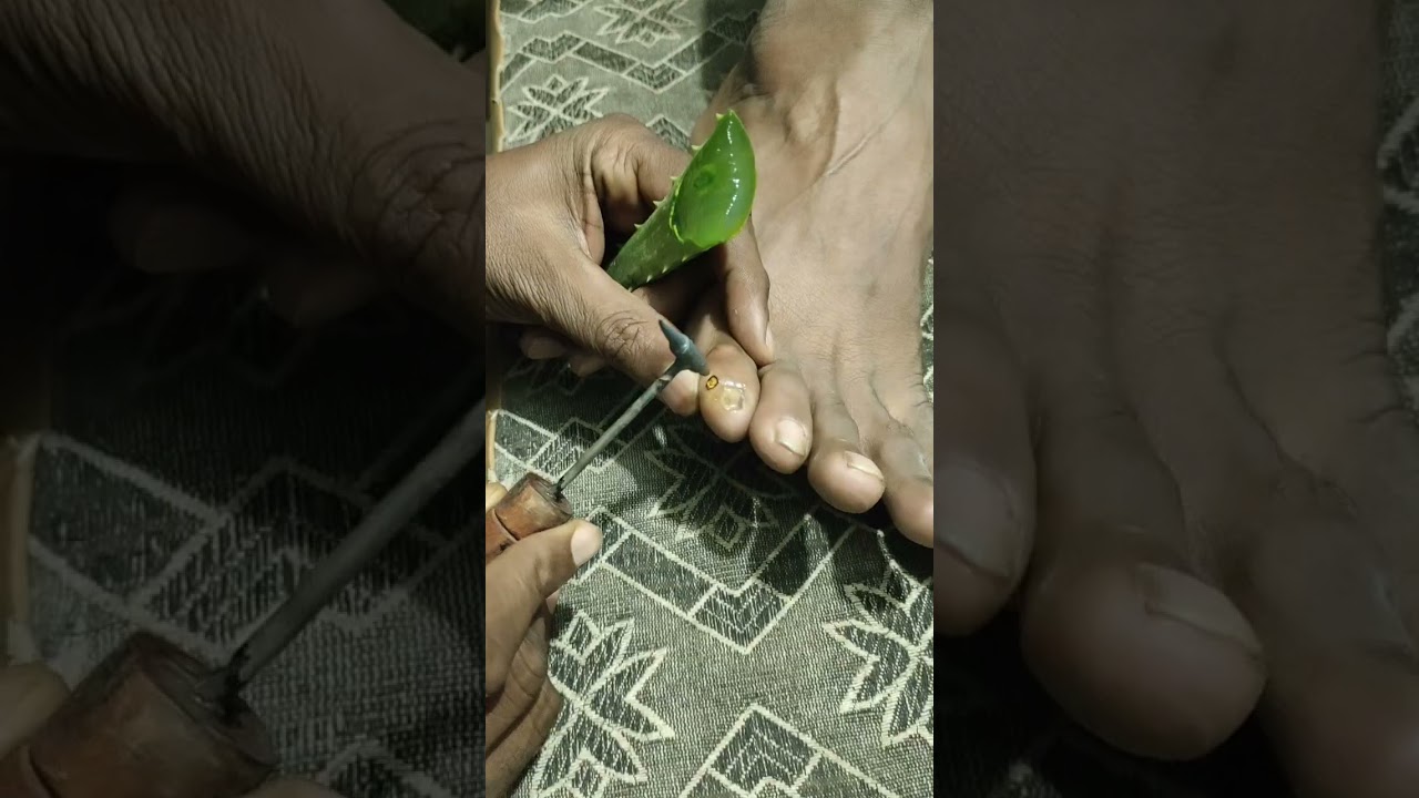 Foot corn treatment by #agnikarma #treanding