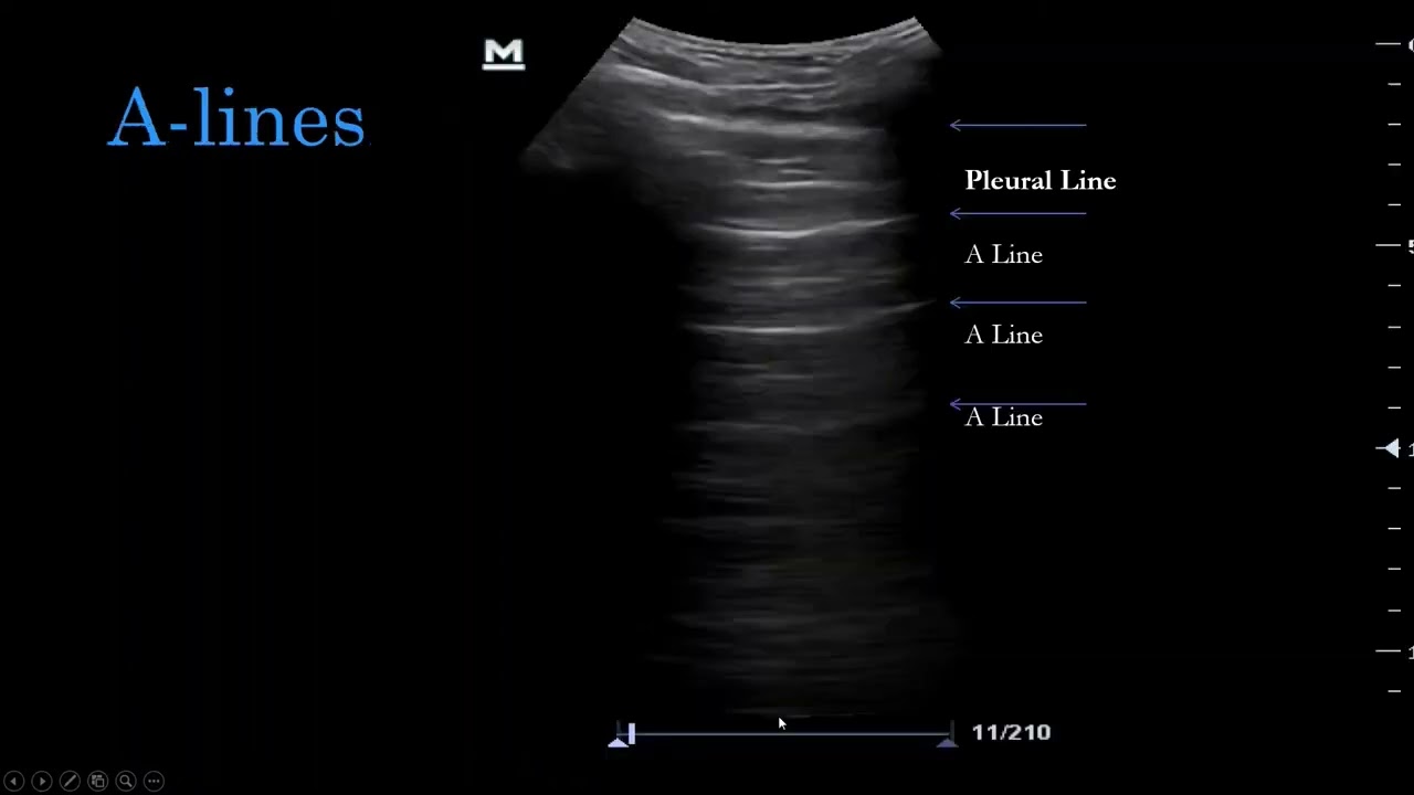 Lung  Scan Technique  & A line B lines