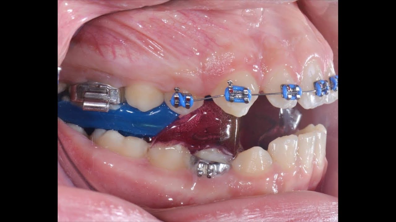 شرح بسيط تقويم الفكين ثابت ولا متحرك … و اجابات على اسئله تقويم الأسنان - Braces - Fixed Twin Block