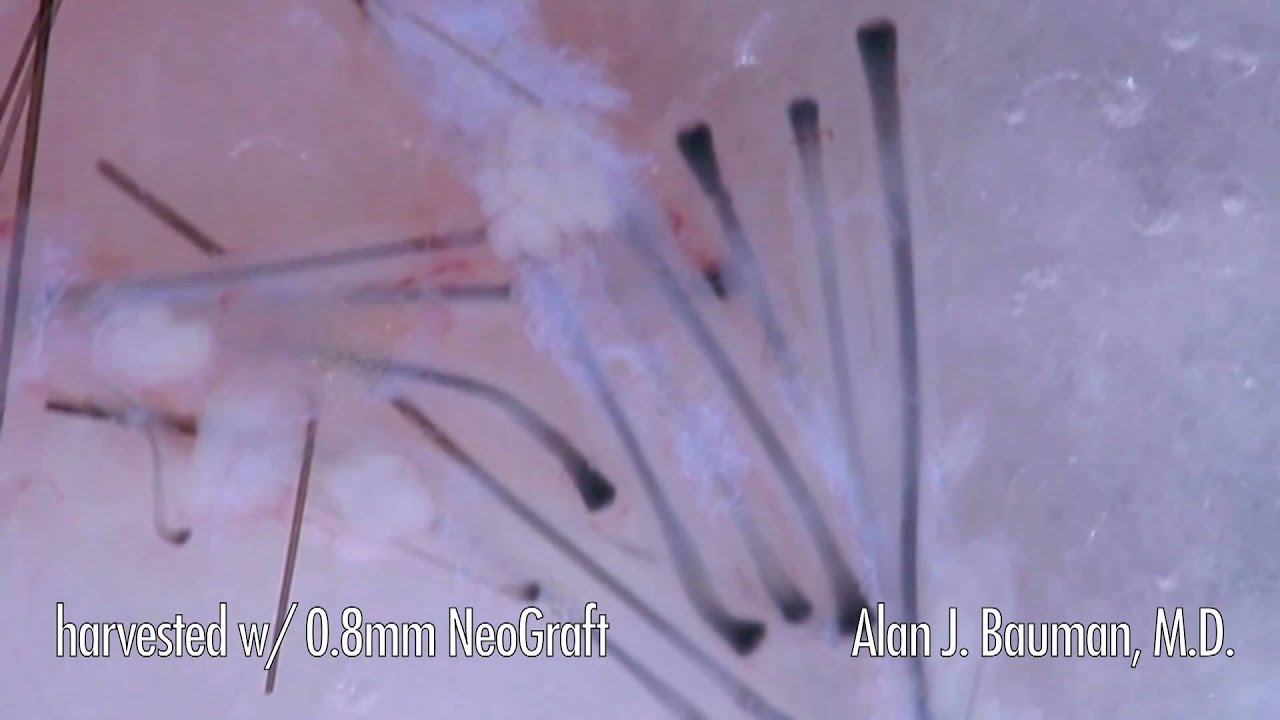 What do FUE NeoGrafts look like in HD?