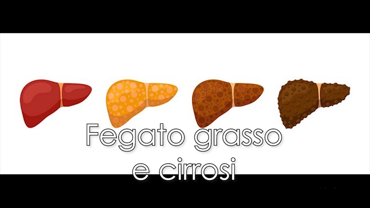 Malattie del fegato: fegato grasso e cirrosi