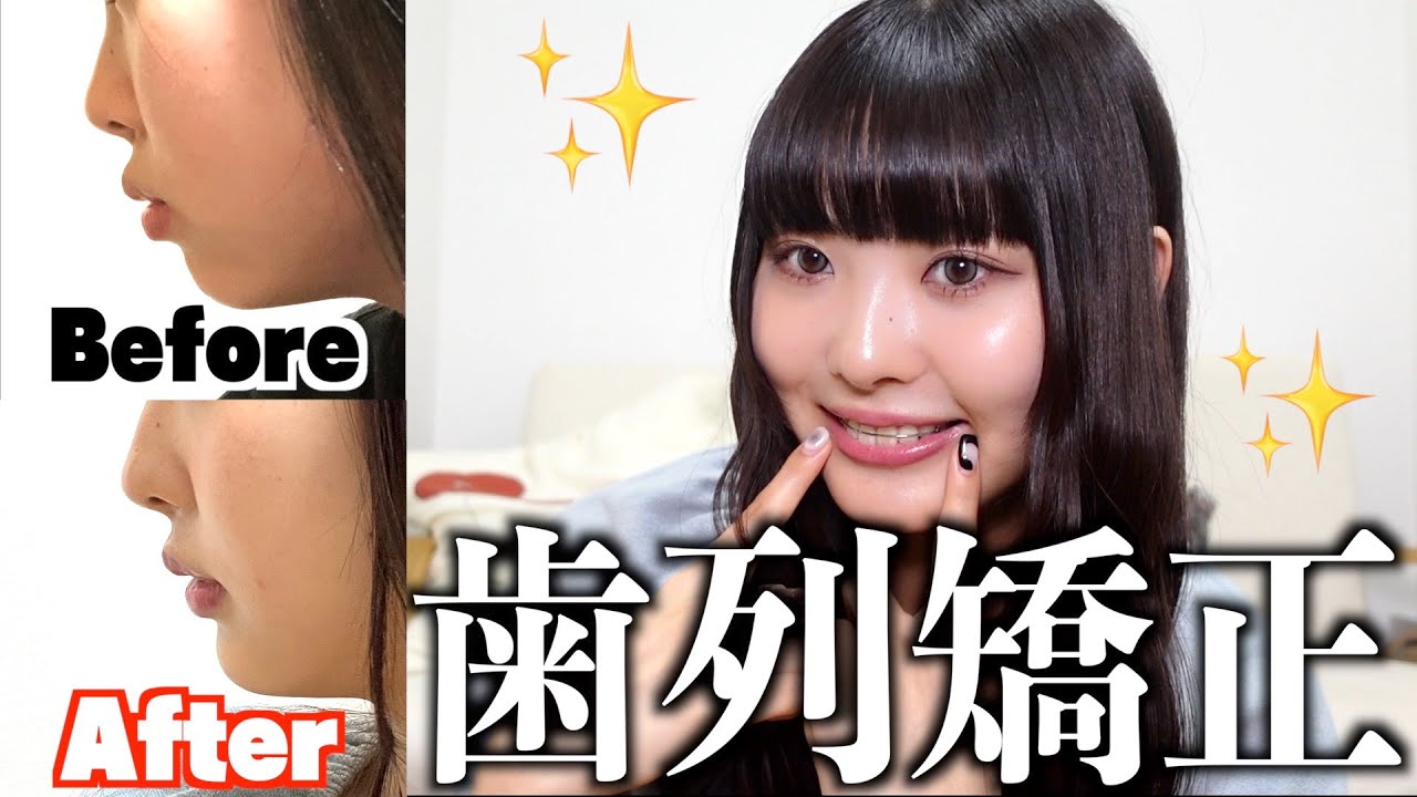 【歯列矯正】総額〇〇万円！？初めての歯列矯正、真実を全て話します