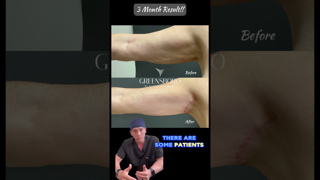 💪 SHORT SCAR BRACHIOPLASTY 💪