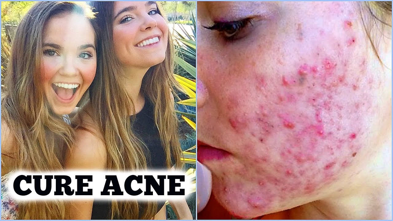 CYSTIC ACNE CURED FOR GOOD- Introducing Dr. McDougall