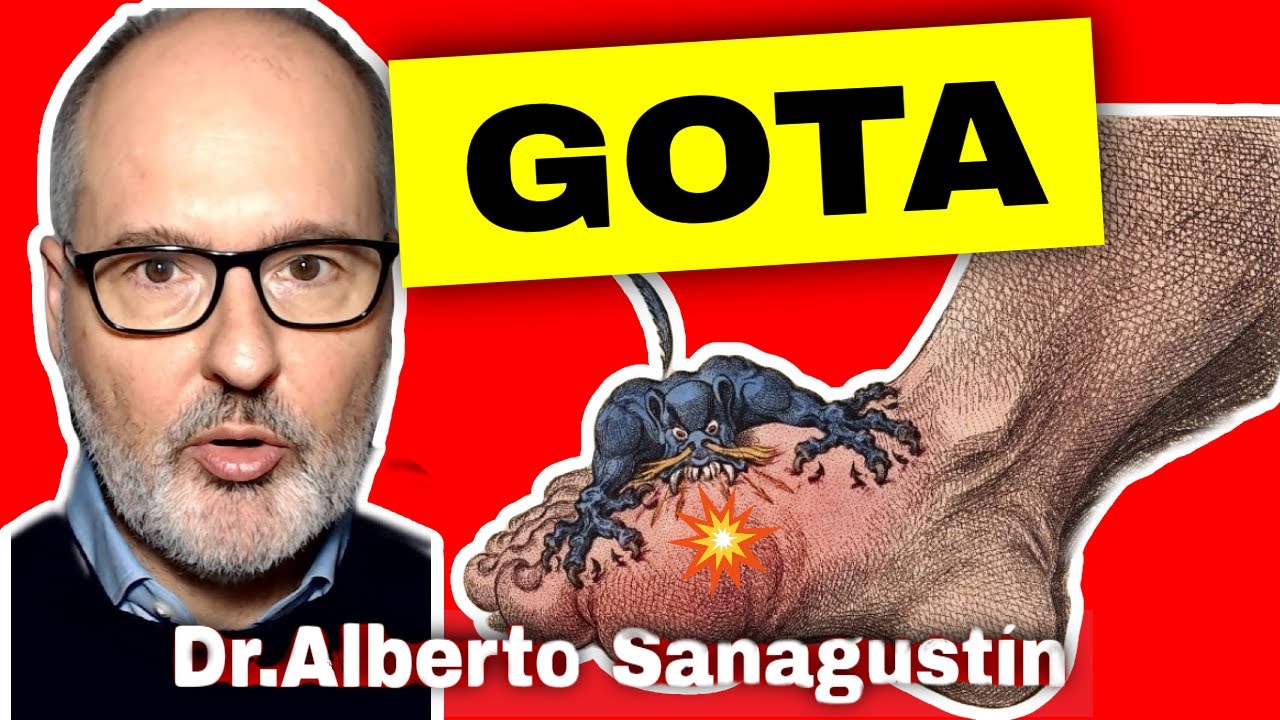 GOTA 💥 Causas, Síntomas y Tratamiento (acido úrico alto)