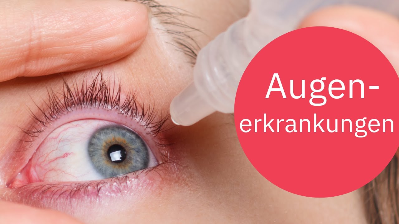 Trockene Augen, Bindehautentzündung, Gerstenkorn - Wertvolle Tipps aus der Apotheke