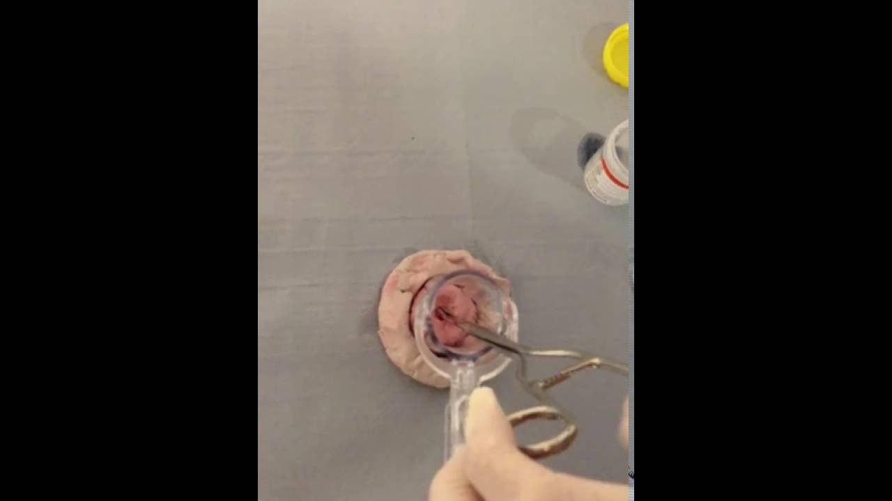 Removal of a Cervical Polyp