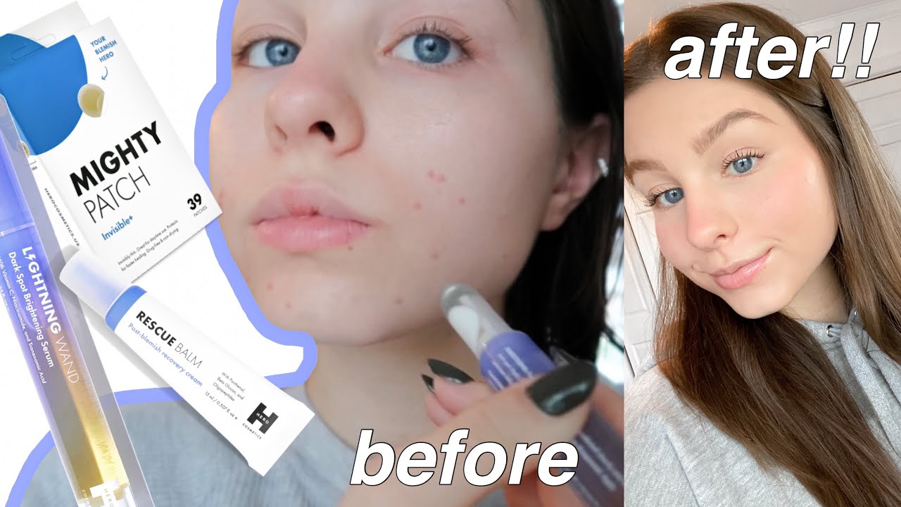 HOW I GOT RID OF MY ACNE SCARS ft. Hero Cosmetics lightening wand