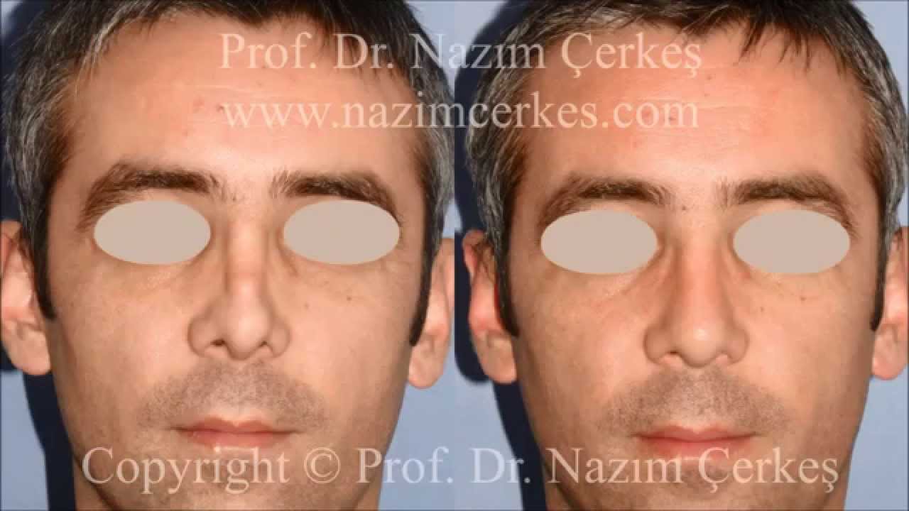 ERKEKLERDE BURUN REVİZYON AMELİYATI | PROF DR NAZIM ÇERKEŞ