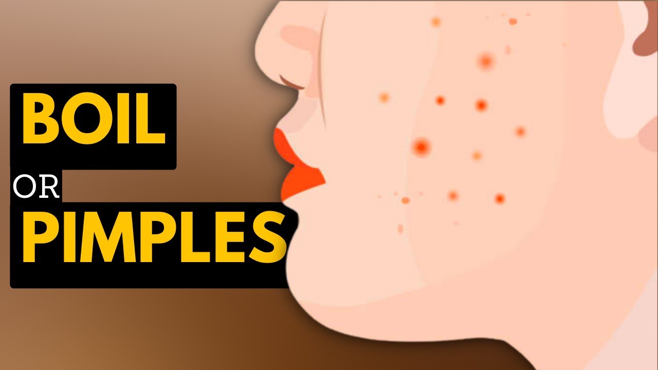 Boils vs. Pimples: What's the Difference and How to Treat Them