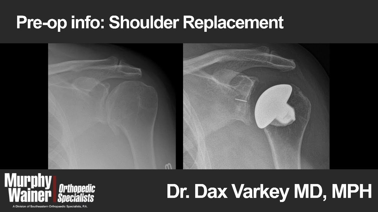 Pre-op info: Shoulder Replacement Surgery