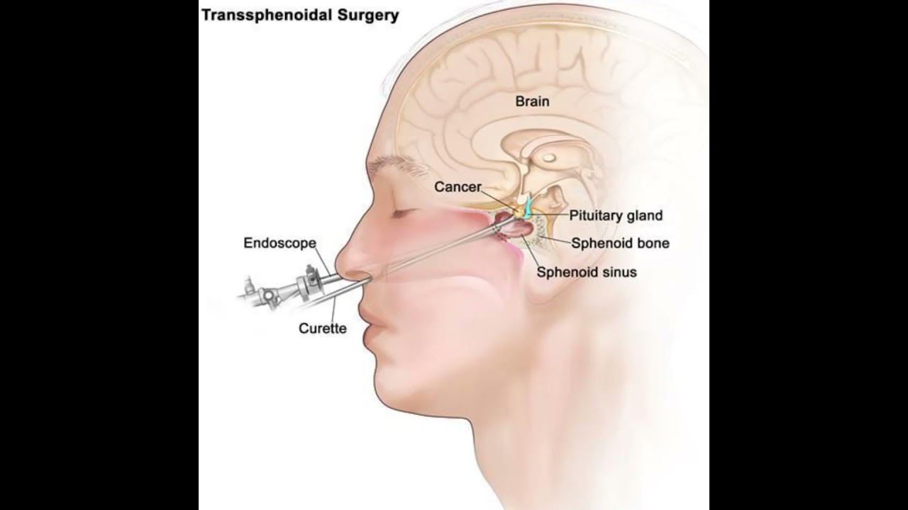 Transsphenoidal Surgery!!! pituitary tumor!!! #doctor #medical #shorts