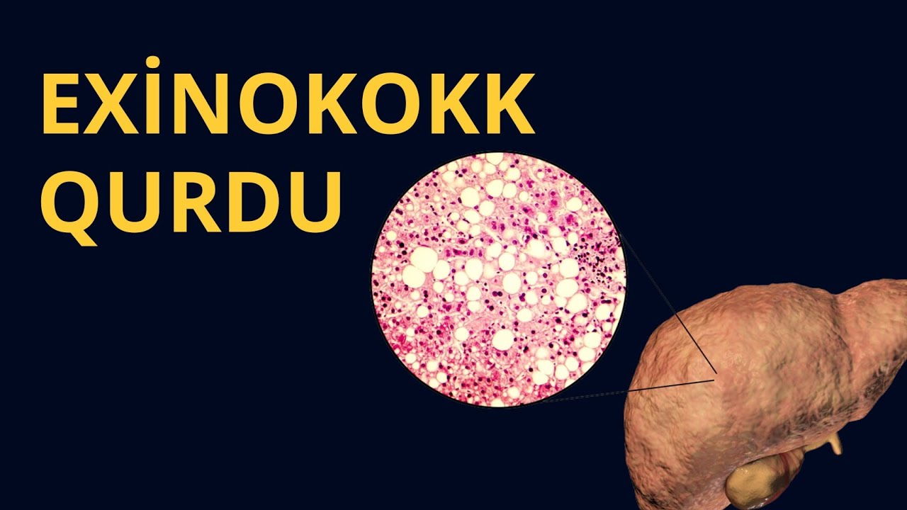 AĞCİYƏR, DALAQDA KİSTA YARADIR: Exinokokk qurdu / Toğrul Ömərov