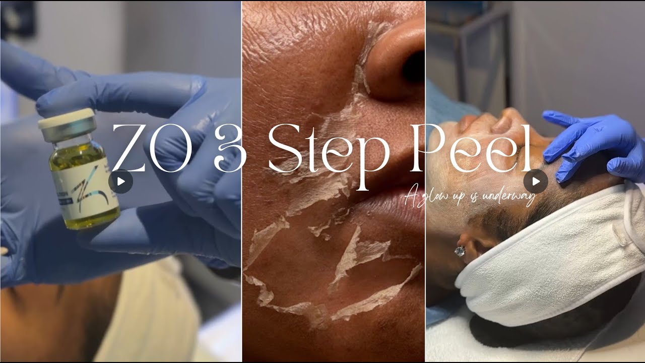 ZO 3 Step Peel | Hyperpigmentation | Texture | Acne