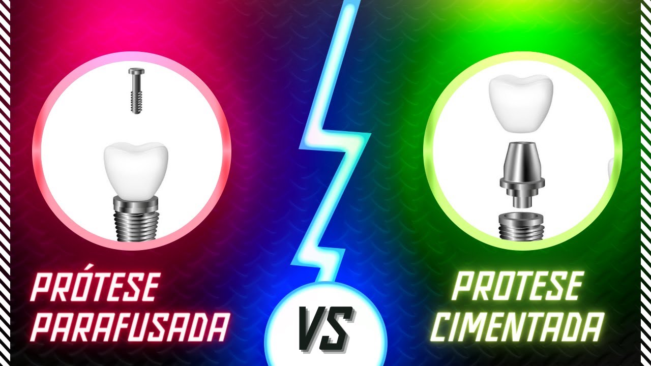 PROTESE PARAFUSADA E PR&Oacute;TESE CIMENTADA SOBRE IMPLANTES - QUAL &Eacute; MELHOR ?