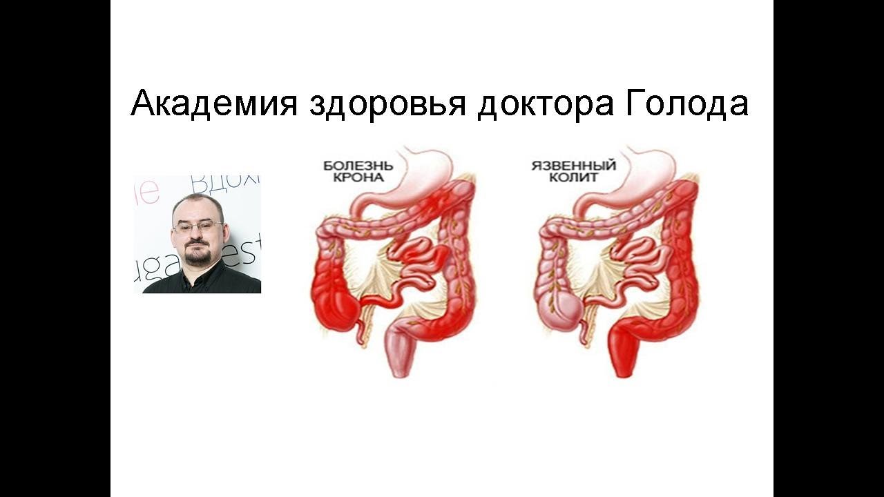 Неспецифический язвенный колит и болезнь Крона.