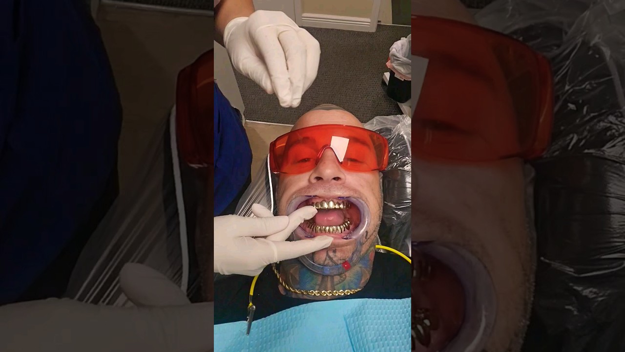32 permanent 22k gold teeth #youtubeshorts #viral #shortvideo #goldteeth #guccimane #gold