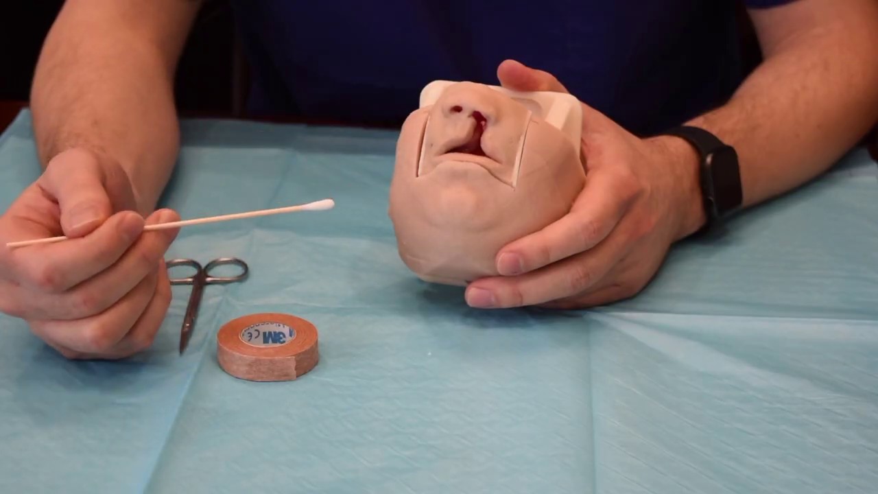Nasal Alveolar Molding Instructions - Dr. Eric Payne - Craniofacial & Plastic Surgeon, Houston, TX