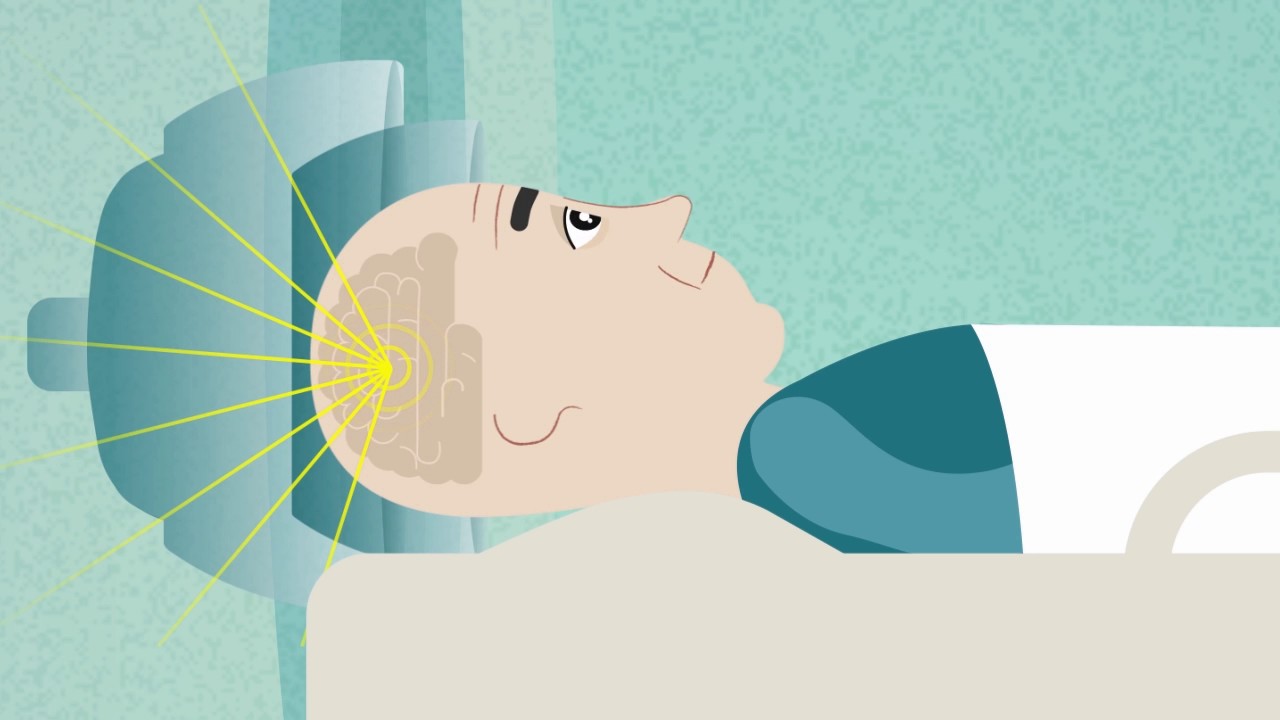 Trattamento con ultrasuoni focalizzati per i tremori dovuti al morbo di Parkinson - Testimonianza: