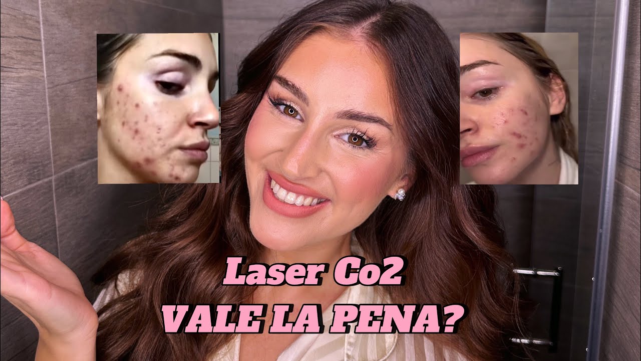 VI RACCONTO LA MIA ESPERIENZA CON IL LASER CO2 PER LE MACCHIE E CICATRICI DA ACNE….LO RIFAREI?