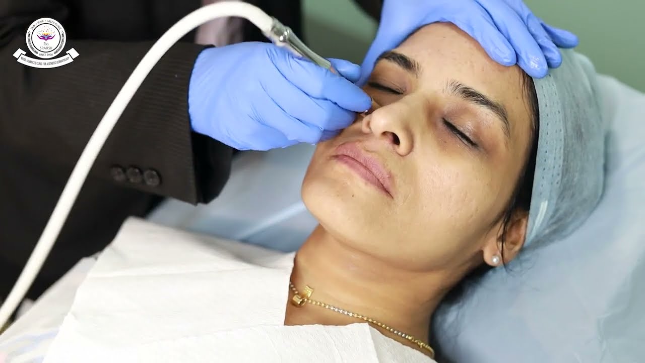 Step by Step Mirapeel Treatment | Sparsh Skin Hair Laser Clinic | Dermatologist in Pune.