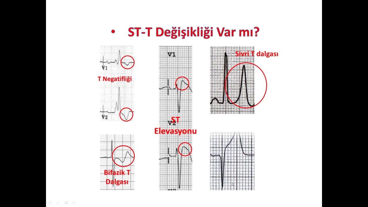 Normal EKG