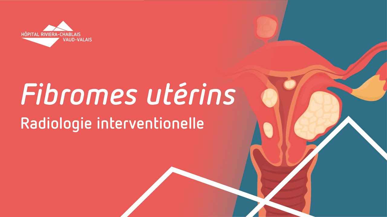 Les fibromes utérins et leur traitement par embolisation