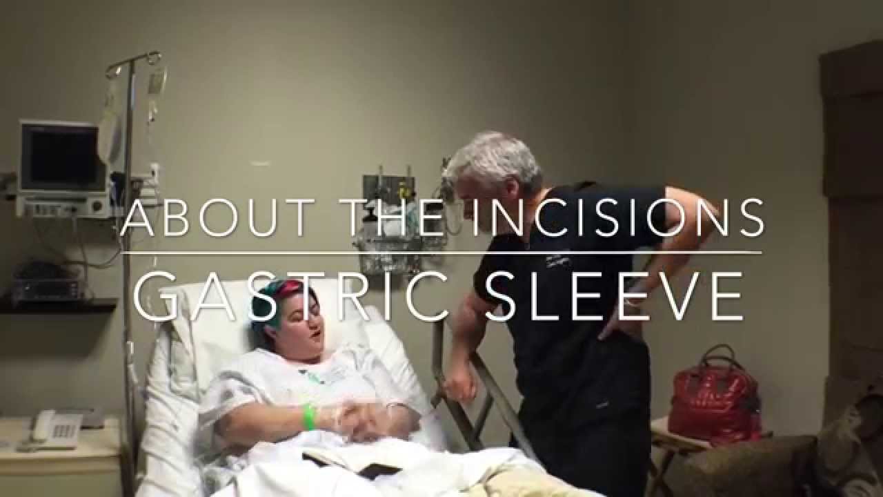 All about Incisions with the Gastric Sleeve - Dr. Ariel Ortiz®