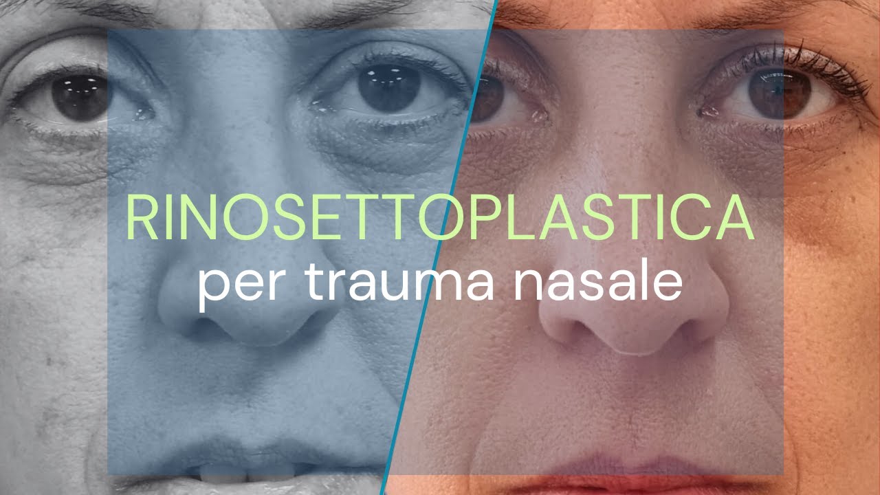 Rinosettoplastica su naso con esiti da trauma