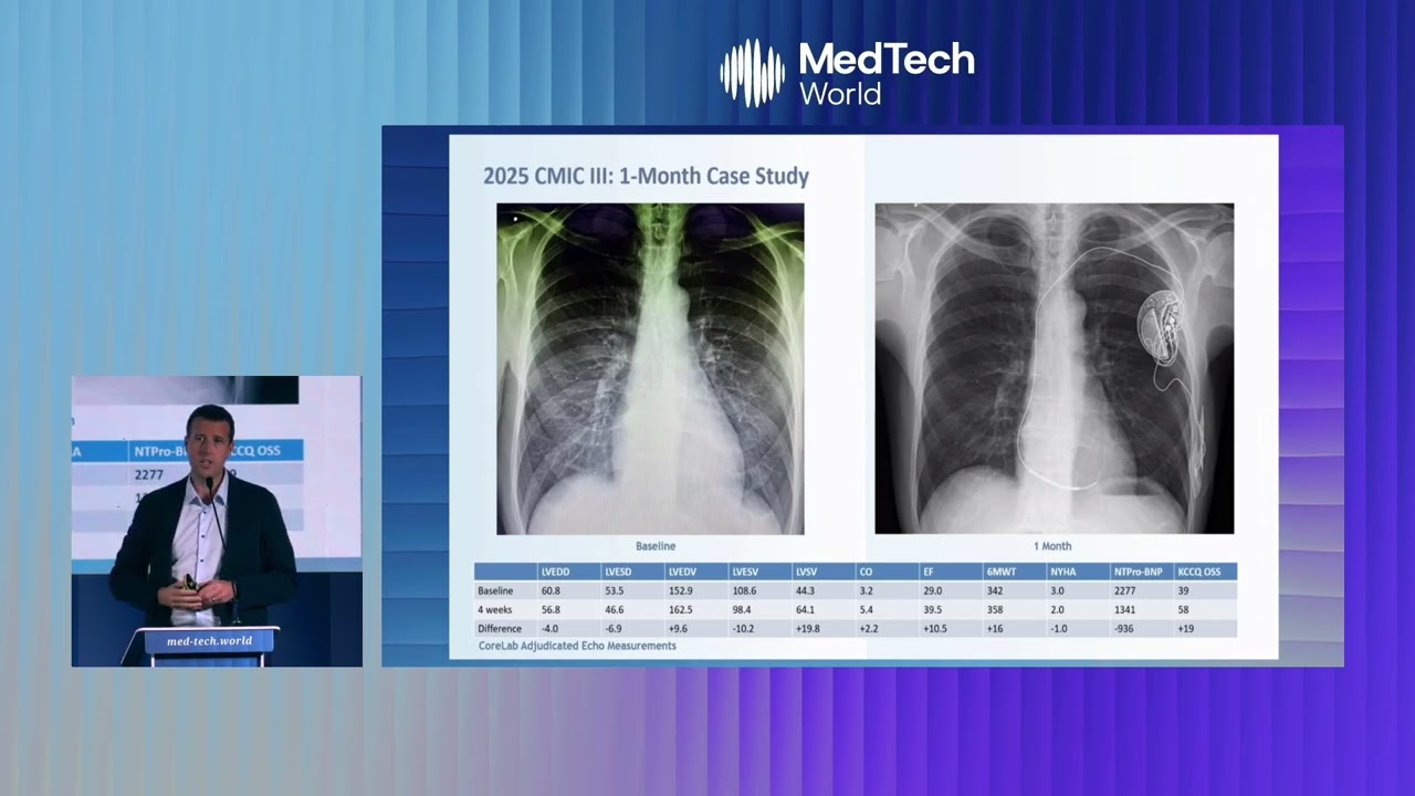 Берлин лечит: электротерапия сердечной недостаточности | MedTech Malta 2025