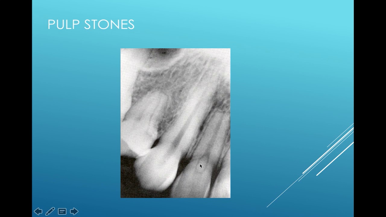 Interpretation of Pulp Lesions Trauma Source